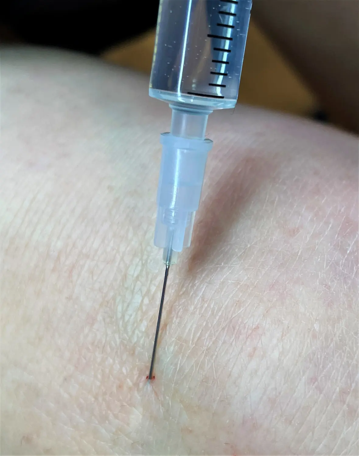 Silvia Schötz Naturheilpraxis Narbenbehandlung